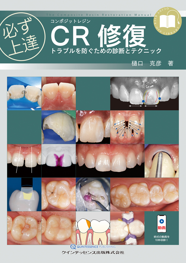 CR修復 樋口克彦著 必ず上達 CR(コンポジットレジン)修復: トラブルを防ぐための