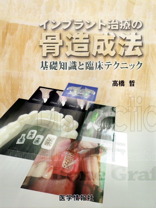 シエン社 | インプラント治療の骨造成法