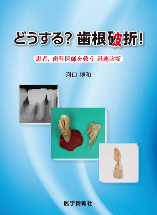 高級品市場 シエン社 | どうする？ 歯根破折！ 歯科学
