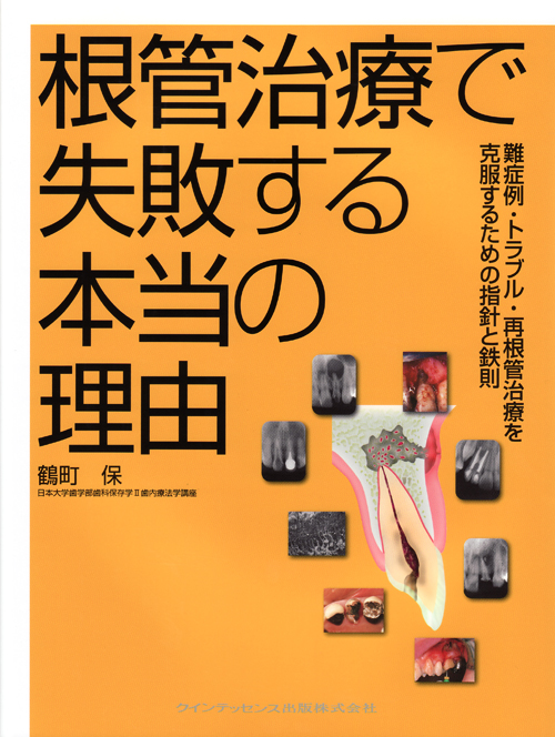根管治療で失敗する本当の理由 難症例・トラブル・再根管治療を克服するための指針… シエン社 | 根管治療で失敗する本当の理由
