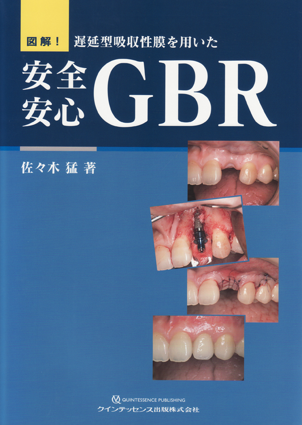 図解! 遅延型吸収性膜を用いた 安全安心GBR | 佐々木 猛 |本