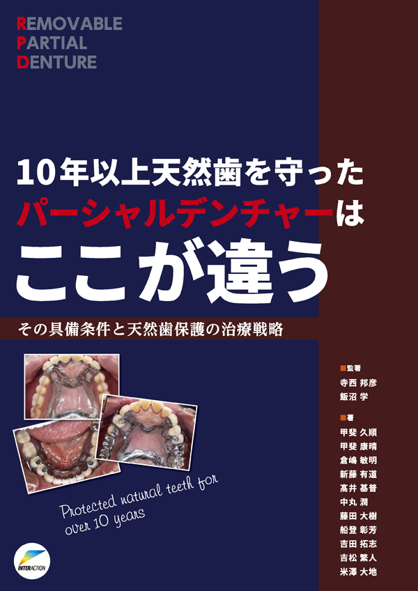 シエン社 | 10年以上天然歯を守ったパーシャルデンチャーは
