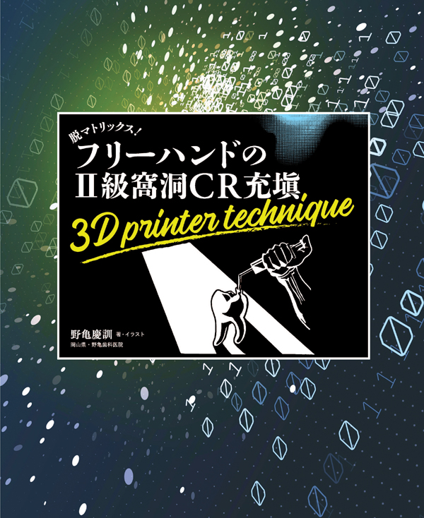 高級ブランド シエン社 | フリーハンドのII級窩洞CR充填 脱マトリックス！ 健康・医学