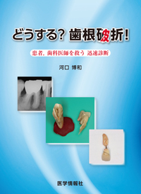 流行り の ブランド  シエン社 歯根破折！ どうする？ | 歯科学