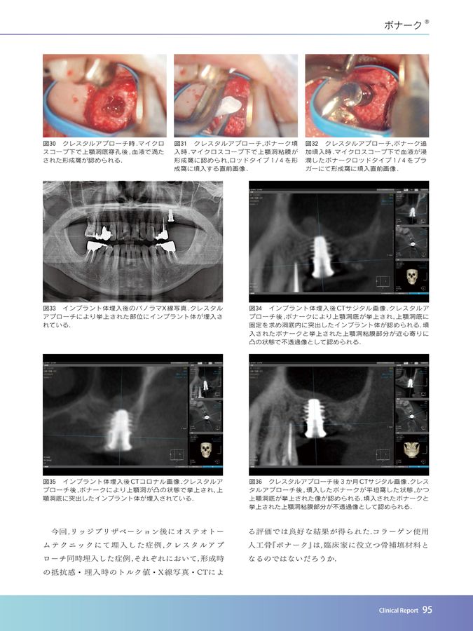 骨増生テクニック&骨補填材料2020国内トレンド
