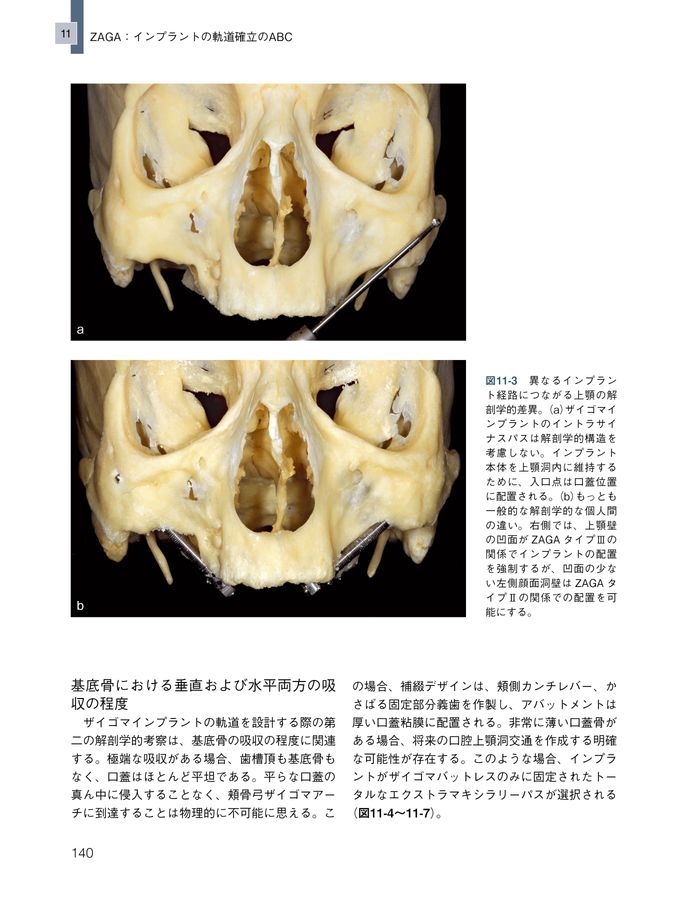 ZYGOMATIC IMPLANTS 日本語版