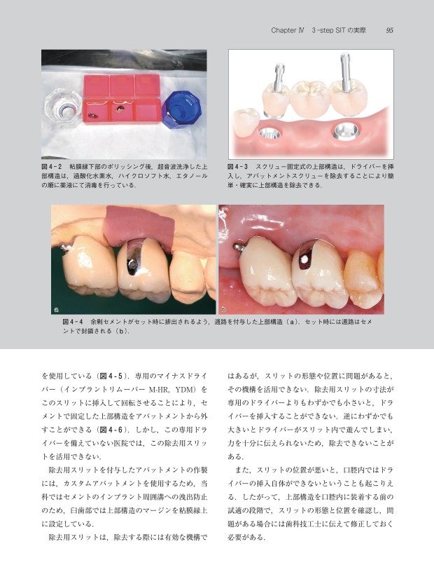 サポーティブ・インプラント・セラピー