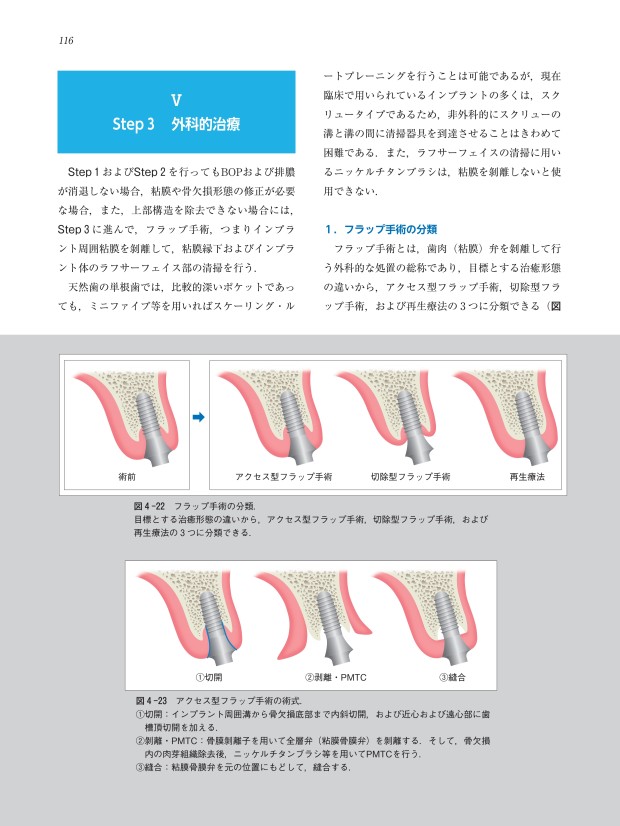 サポーティブ・インプラント・セラピー