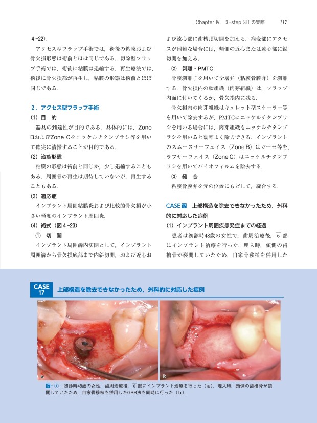 歯周・インプラント治療における再生療法 : Flap stabilityとSo… 歯周・インプラント治療における再生療法 - クインテッセンス出版