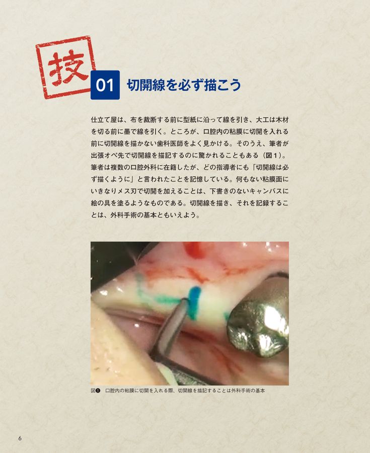 インプラント小技帖50 書籍詳細「インプラント小技帖50」 | フォルディネット