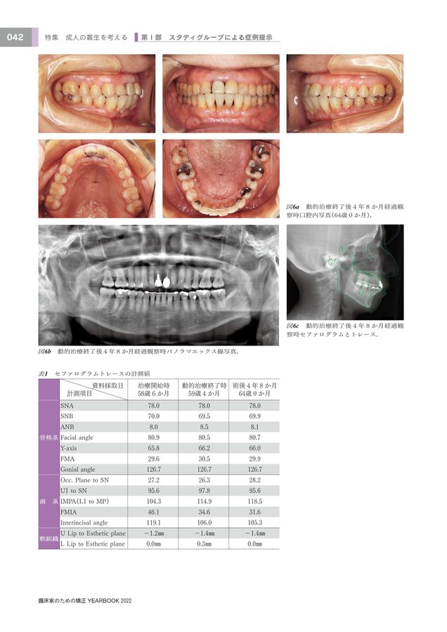 歯科矯正学 Amazon.co.jp: 歯科矯正歯モデル - 歯科矯正ブレース歯モデル