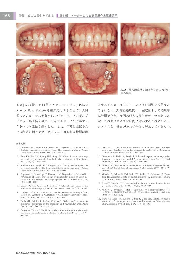 歯科矯正学 Amazon.co.jp: 歯科矯正歯モデル - 歯科矯正ブレース歯モデル