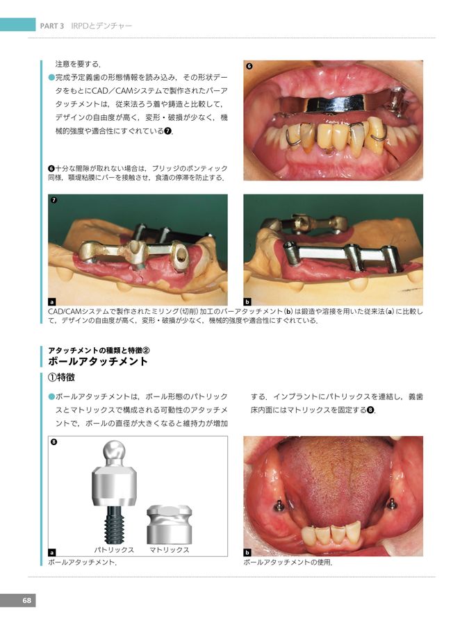 最新IRPDインプラントパーシャルデンチャーの実践