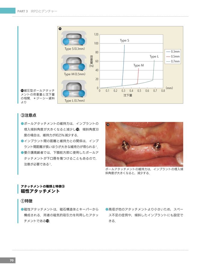 最新IRPDインプラントパーシャルデンチャーの実践 最新IRPDインプラントパーシャルデンチャーの実践