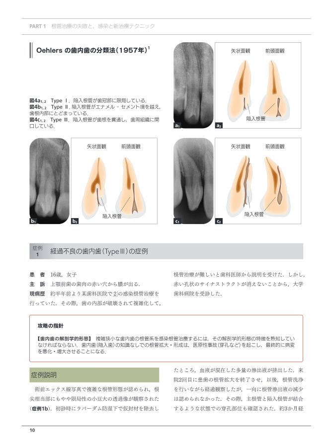 あなたの根管治療はここがまちがっている！