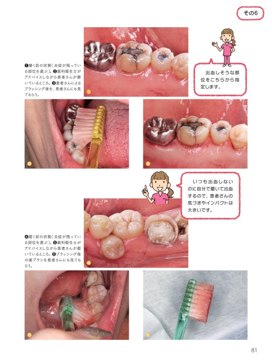 そのまま使える！ スキルも上がる！ ブラッシング指導テクニック