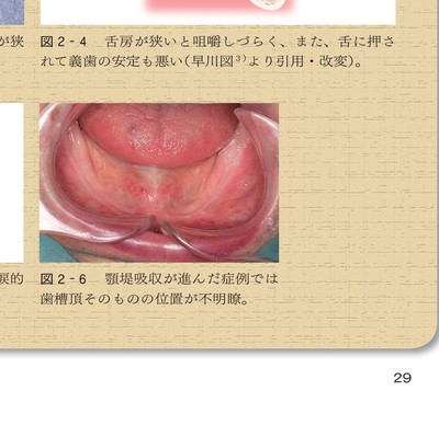 よい義歯 だめな義歯