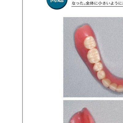よい義歯 だめな義歯