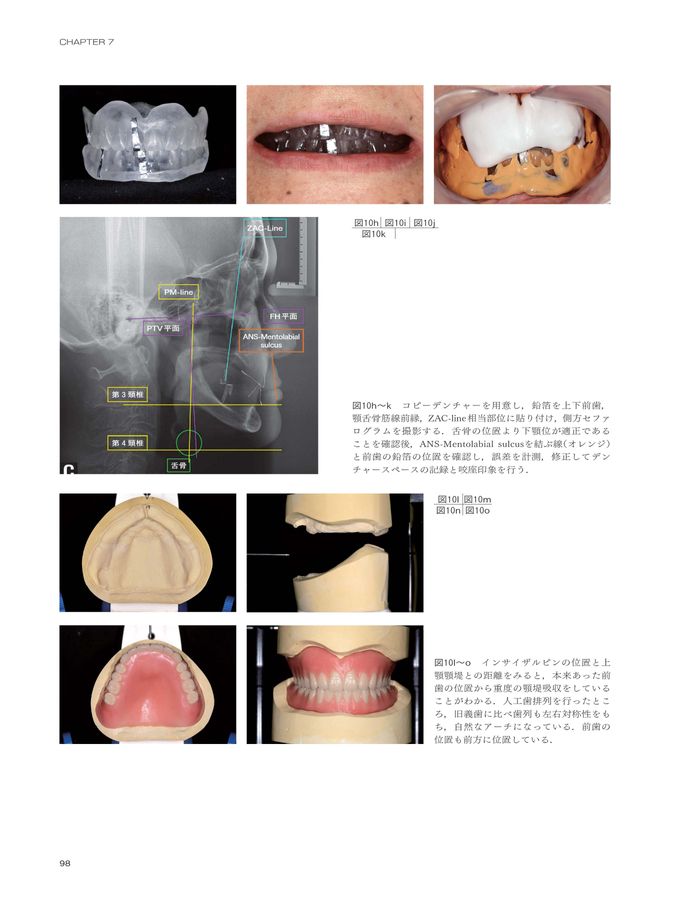 無歯顎補綴の治療戦略_NoLink