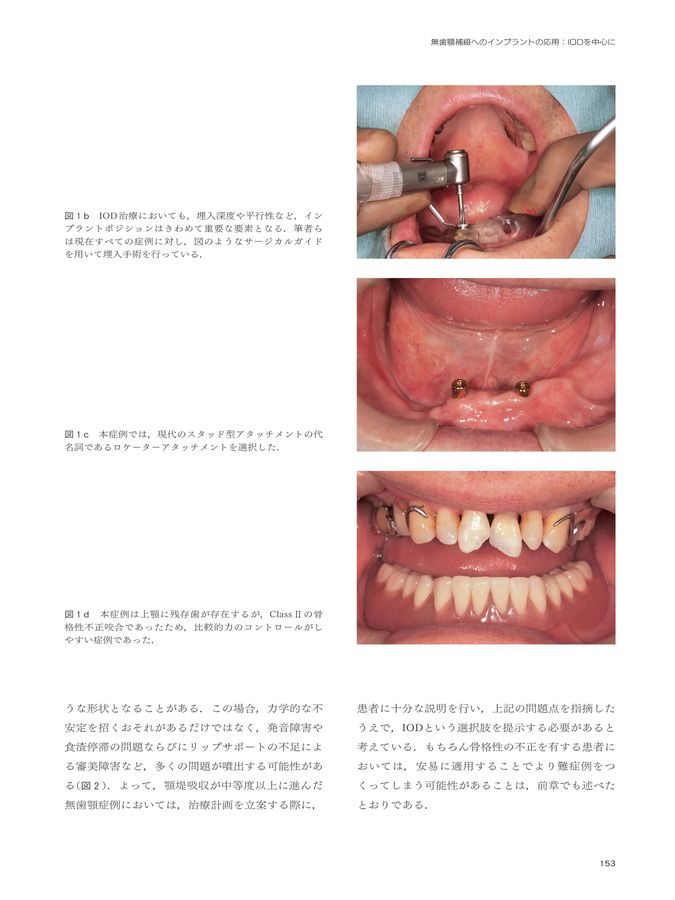 無歯顎補綴の治療戦略_NoLink