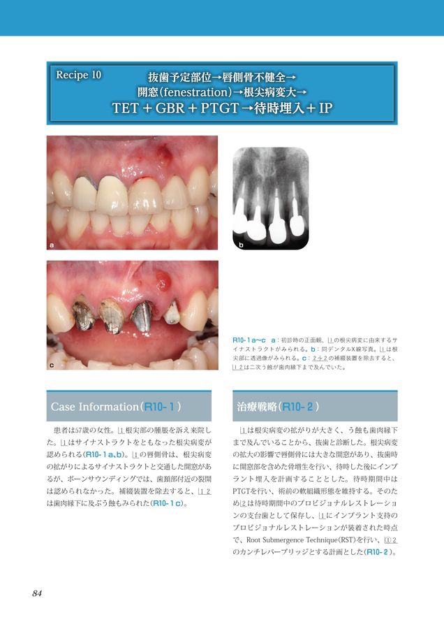 審美インプラントの治療戦略