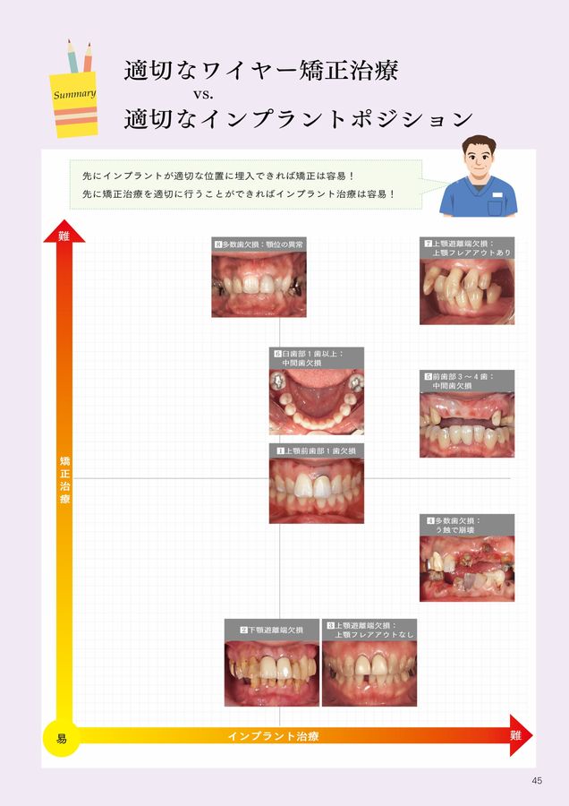 矯正が先か? インプラントが先か?: 欠損補綴の治療計画を極める
