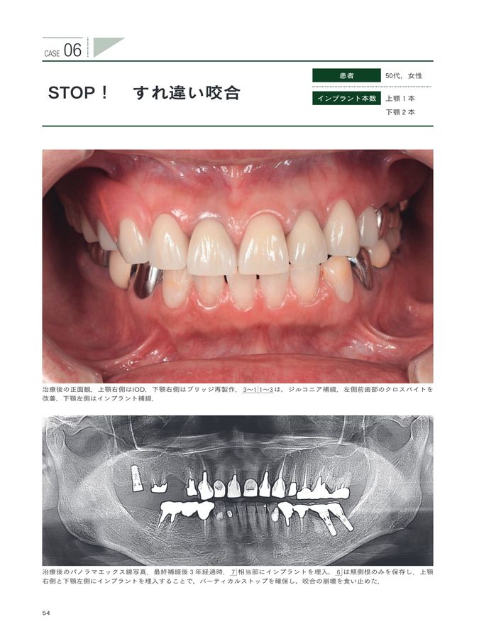 みんなにやさしいマグネットデンチャー: Dr.もDHも患者さんも介護者にも! 出版記念講演】IOD みんなにやさしいマグネットデンチャー