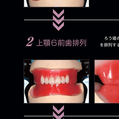 保険総義歯のススメ