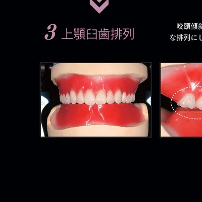 保険総義歯のススメ