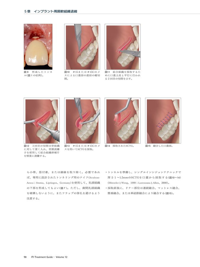 ITI Treatment Guide Vol12