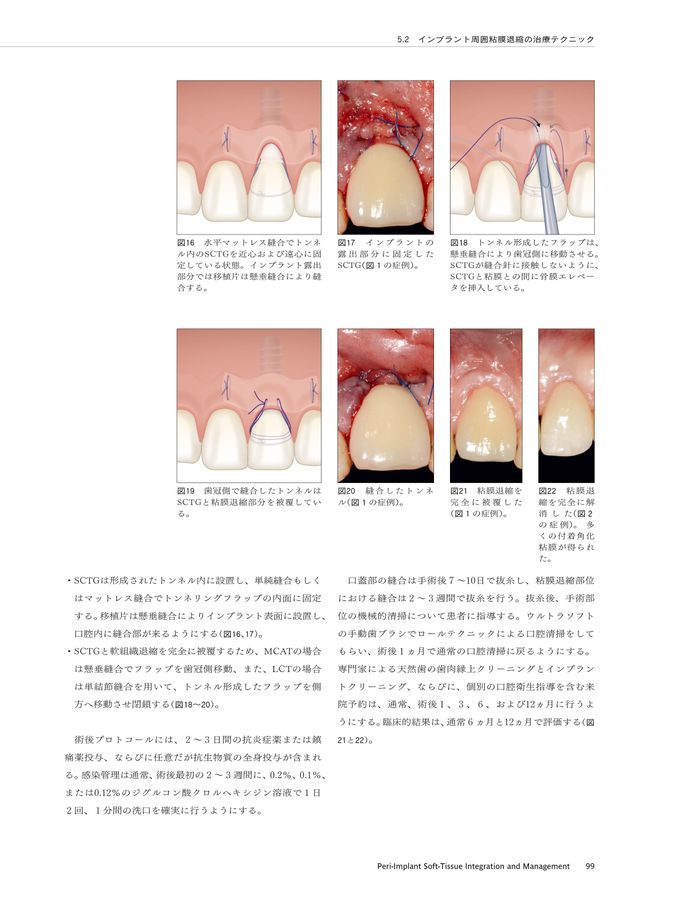 ITI Treatment Guide Volume 2 ※非裁断 ITI Treatment Guide Volume 2 ※非裁断