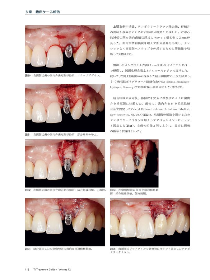 ITI Treatment Guide Vol12
