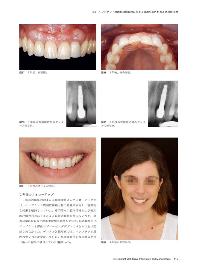 ITI Treatment Guide Vol12