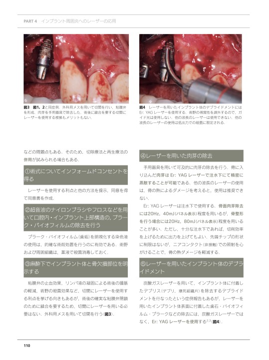 インプラント周囲炎とレーザー | 渡辺 久, 一般社団法人日本