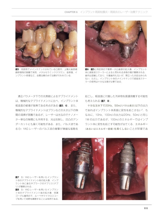 インプラント周囲炎とレーザー | 渡辺 久, 一般社団法人日本