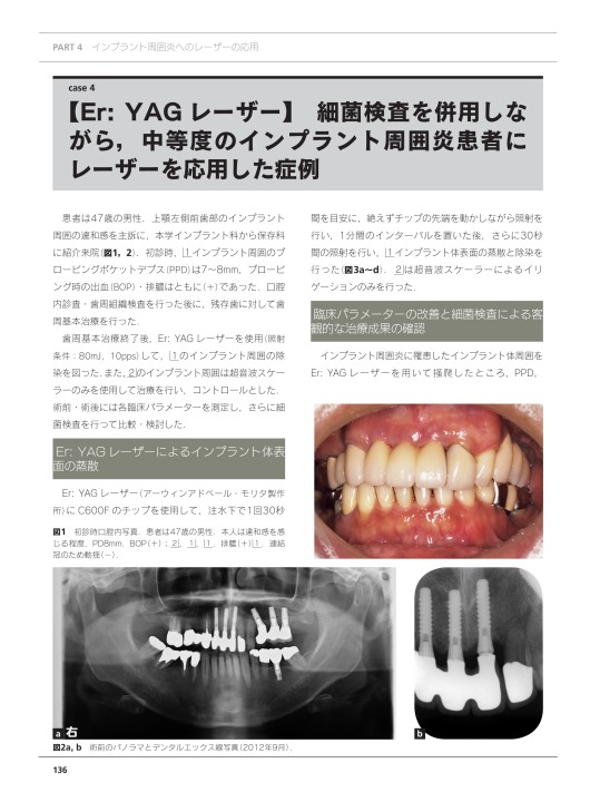 インプラント周囲炎とレーザー インプラント周囲炎とレーザー - クインテッセンス出版