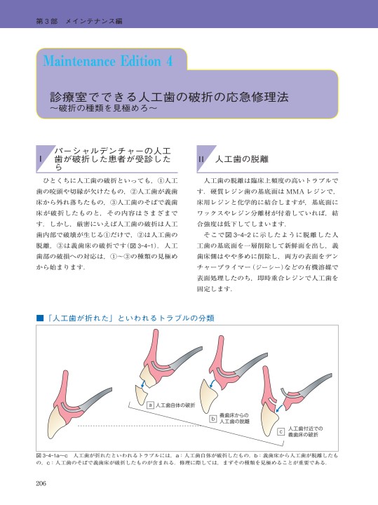 パーシャルデンチャー治療 失敗回避のためのポイント47