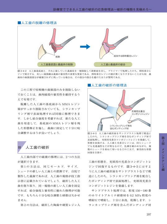パーシャルデンチャー治療 失敗回避のためのポイント47