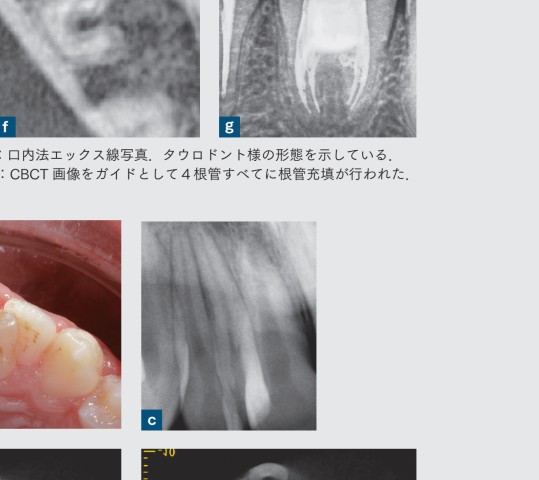 歯内療法成功のためのコーンビームCT活用法