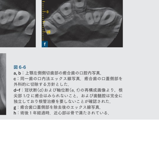 【裁断済み】コーンビームCT活用術 歯内療法成功のためのコーンビームCT活用術 - クインテッセンス出版