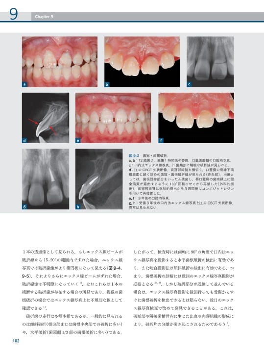 歯内療法成功のためのコーンビームCT活用法