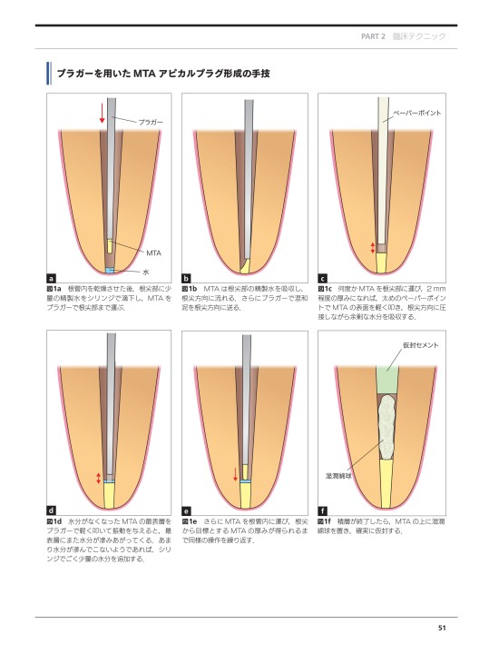 検証MTA
