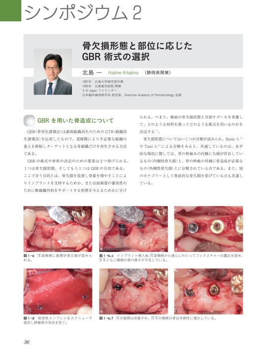 GBRの歯科インプラントへの応用 骨や歯茎が不足している部分へのインプラント治療例（GBRとFGGの