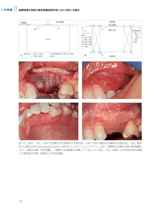 垂直的および水平的歯槽堤増大術 垂直的および水平的歯槽堤増大術