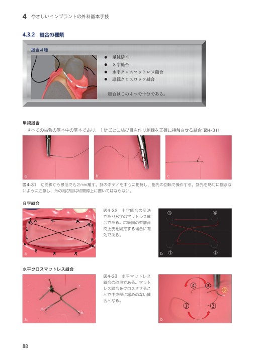 やさしいインプラント治療 初めての1本埋入をガイドします！