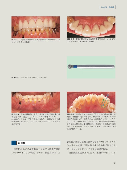 これならわかる 少ないバーでできる生活史の支台歯形成法