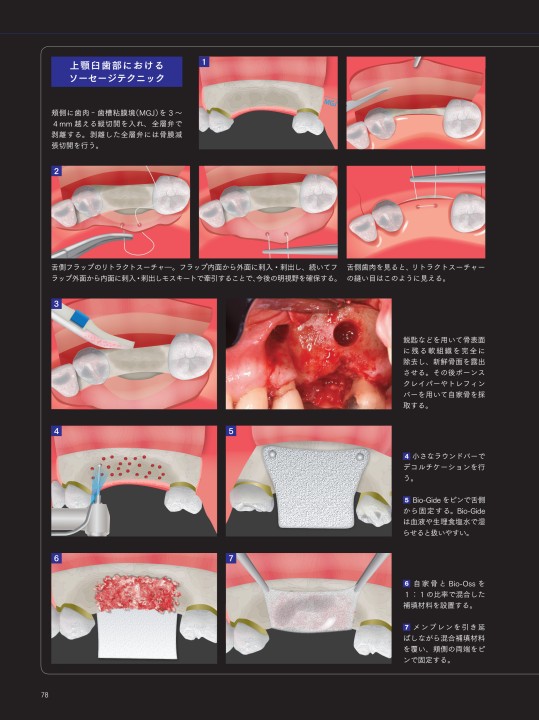 骨補填材料＆メンブレンの歴史的変遷と最新トレンド