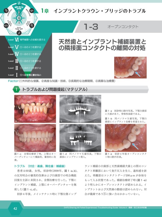 SAFE Troubleshooting Guide Volume 4 補綴・技工的合併症編