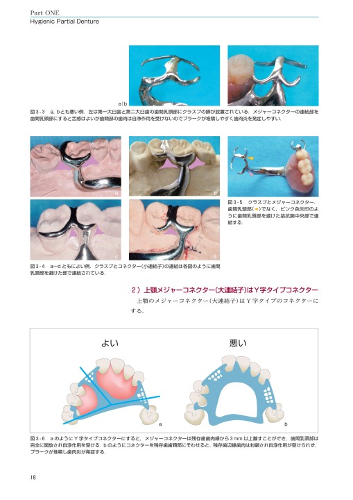 Hygienic Partial DentureとMyo-Dentureの最新臨床アトラス
