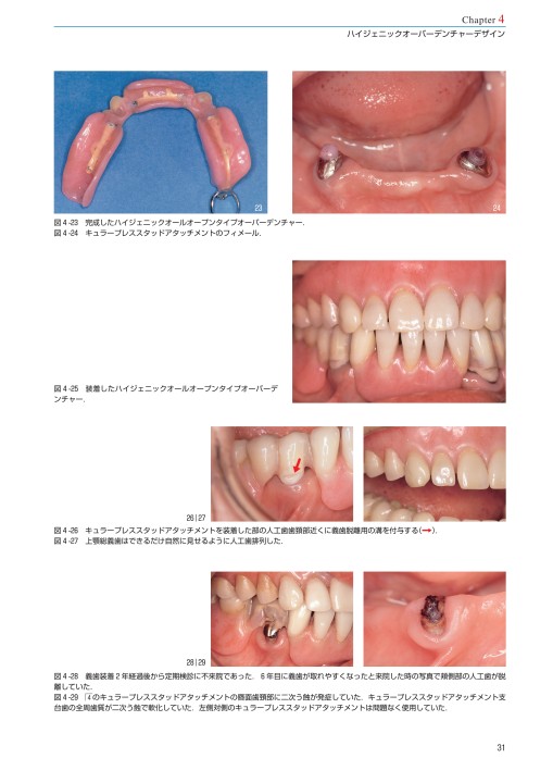 Hygienic Partial DentureとMyo-Dentureの最新臨床アトラス